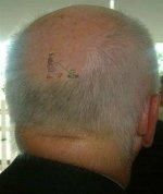 bald.jpg