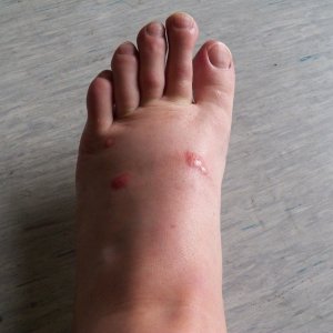 With sand flies, it took three days for the bites to develop.  This is after taking an antihistamine.
