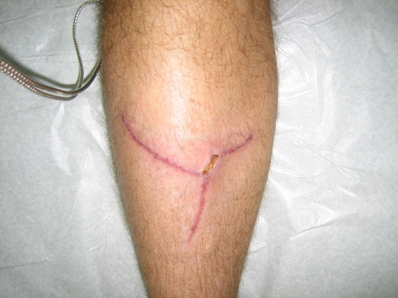 Fell into gap between two marina floats in Hartley Bay, BC.  The bottom leg of the Y was where I just scraped the skin.  It "caught" in the center of the scar, and the two arms of the Y are where the skin tore, lifting a full thickness flap down to the bone.  The wound was gaping open about an inch, and blood was pouring out.  My brother, standing beside me, asked, "do you need a Band-Aid?"  This is a month and 1/2 post injury, and it's healing up nice.