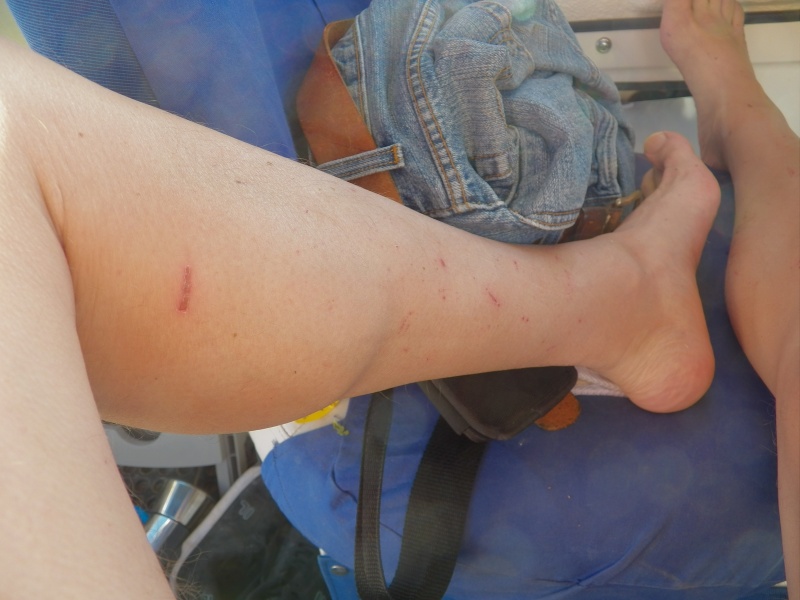 I carry Bactine with me and apply it like sunscreen (also required).  This is before I really got scratched up.